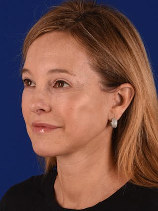 Facelift Before & After Gallery - Patient 143045 - Image 4