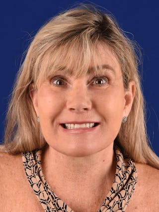 Facelift Before & After Gallery - Patient 140912 - Image 4