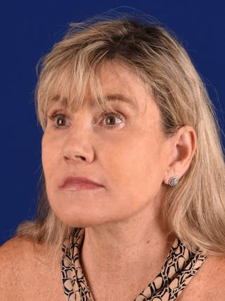 Facelift Before & After Gallery - Patient 140912 - Image 6