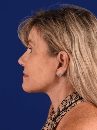 Facelift Before & After Gallery - Patient 140912 - Image 8