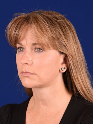 Facelift Before & After Gallery - Patient 138473 - Image 4