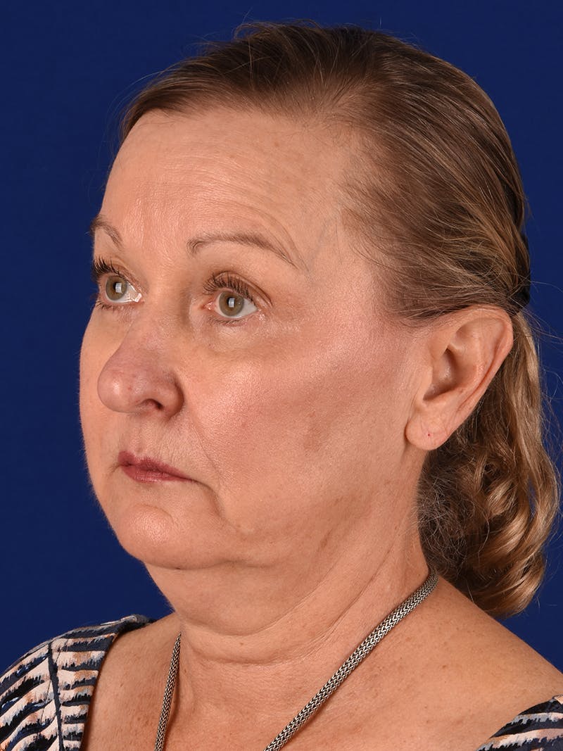 Facelift Before & After Gallery - Patient 196535 - Image 3