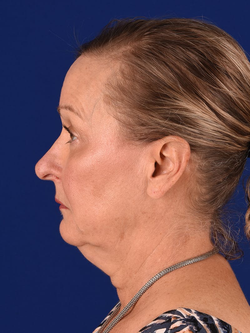 Facelift Before & After Gallery - Patient 196535 - Image 5