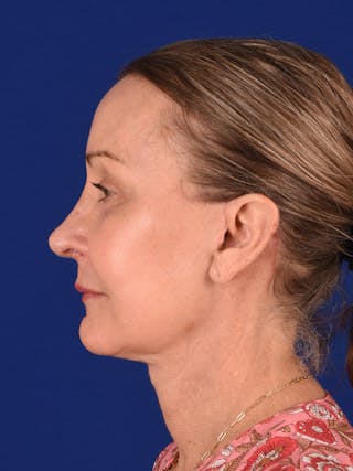 Facelift Before & After Gallery - Patient 196535 - Image 6