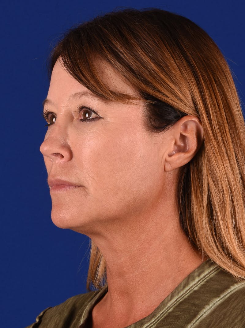 Facelift Before & After Gallery - Patient 349581 - Image 3
