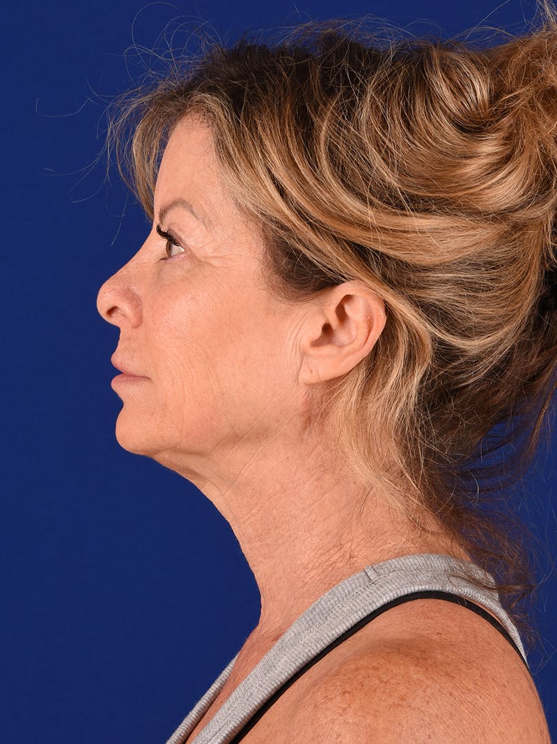 Facelift Before & After Gallery - Patient 911497 - Image 5