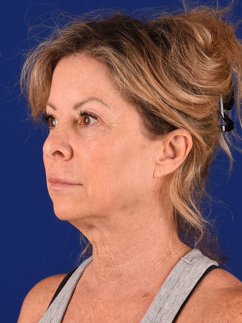 Facelift Before & After Gallery - Patient 911497 - Image 3