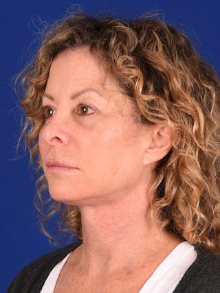 Facelift Before & After Gallery - Patient 911497 - Image 4