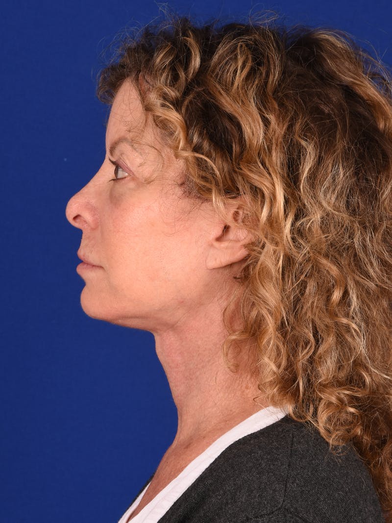 Facelift Before & After Gallery - Patient 911497 - Image 6