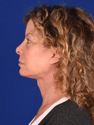 Facelift Before & After Gallery - Patient 911497 - Image 6