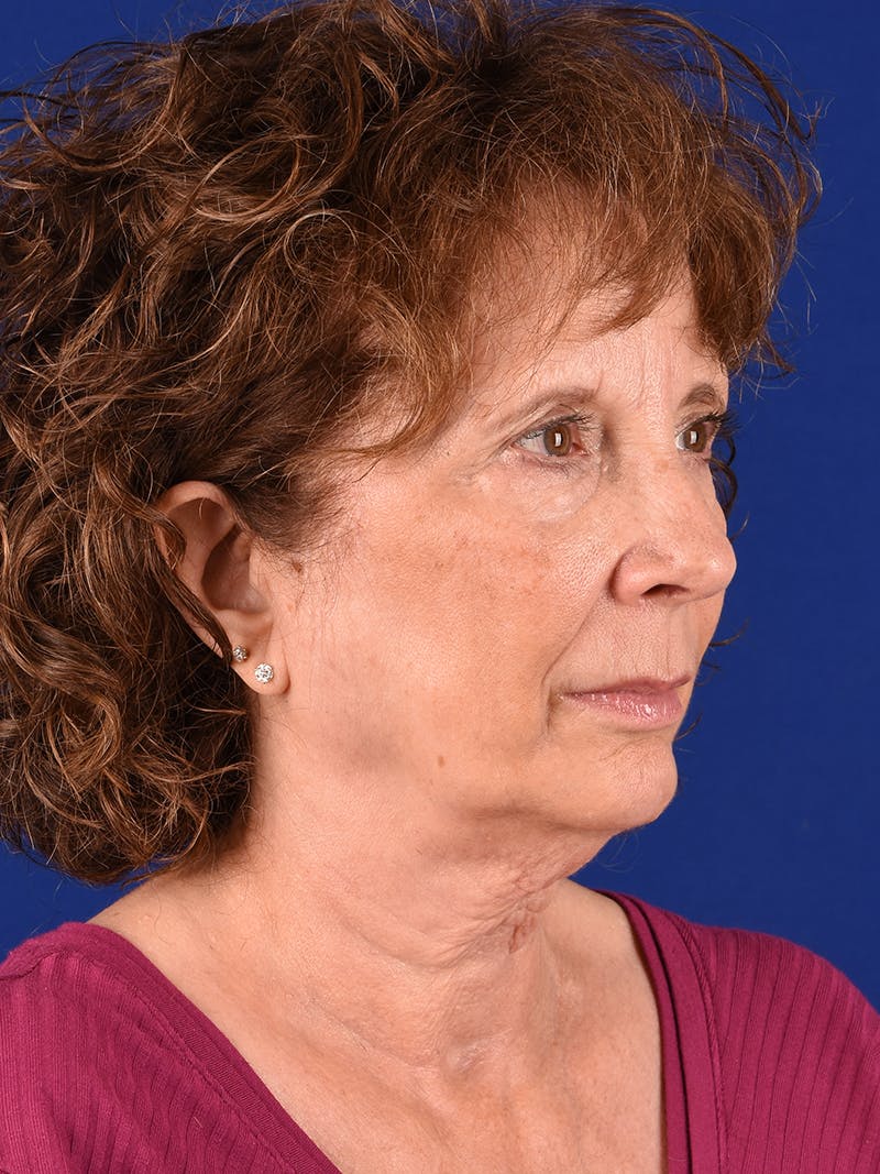 Facelift Before & After Gallery - Patient 392392 - Image 3