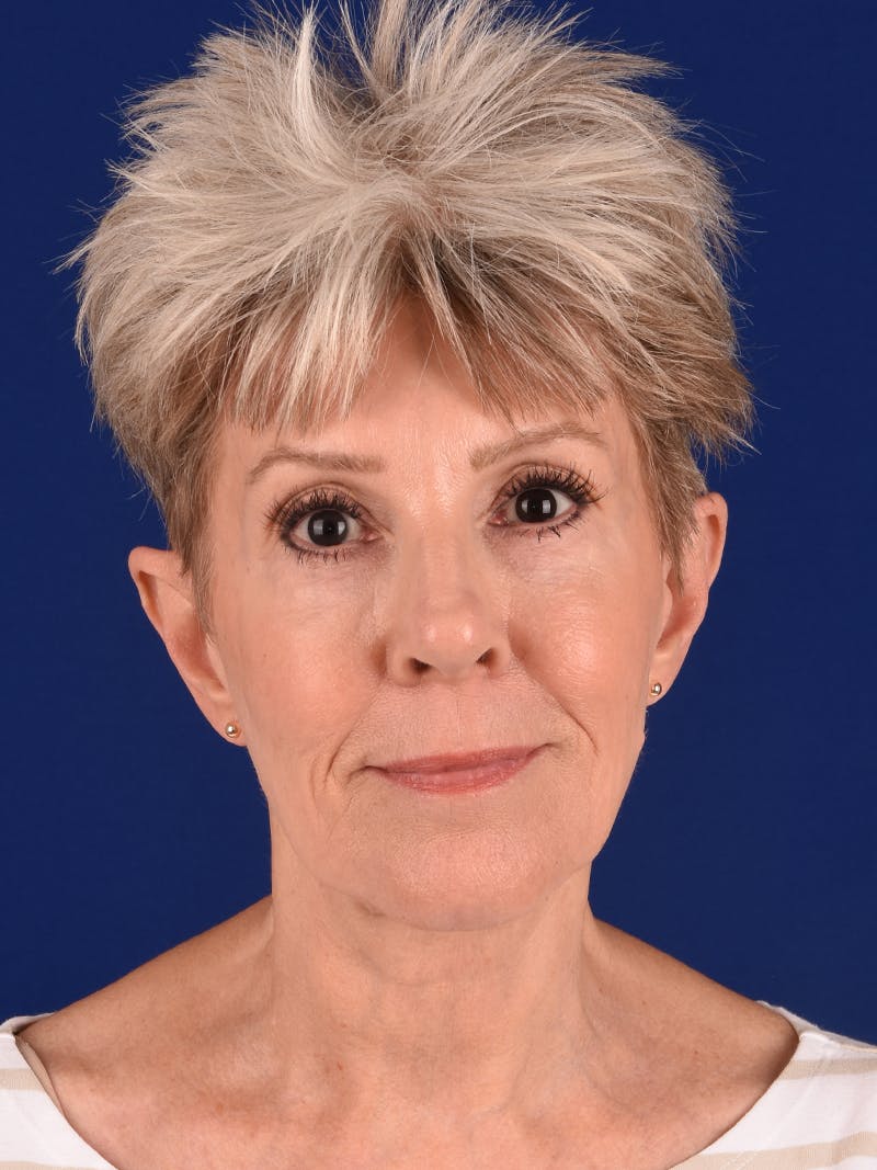 Facelift Before & After Gallery - Patient 291512 - Image 3
