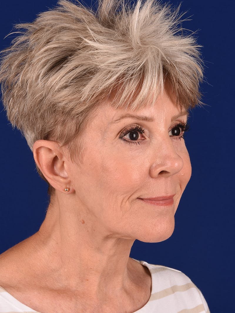 Facelift Before & After Gallery - Patient 291512 - Image 5