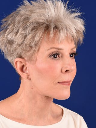 Facelift Before & After Gallery - Patient 291512 - Image 6