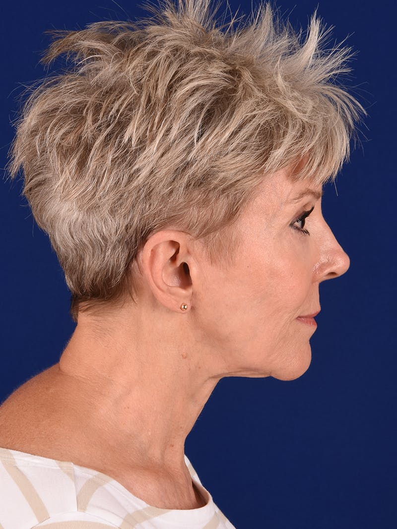 Facelift Before & After Gallery - Patient 291512 - Image 7
