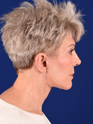 Facelift Before & After Gallery - Patient 291512 - Image 8