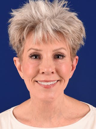 Facelift Before & After Gallery - Patient 291512 - Image 4