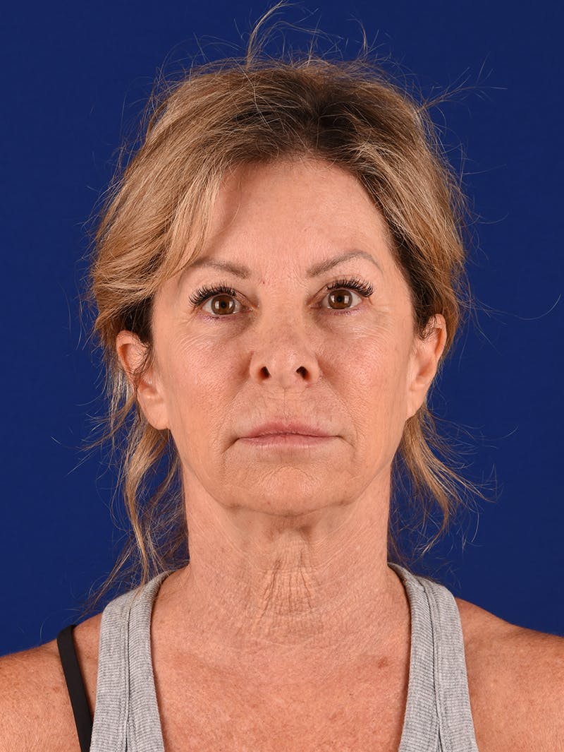 Facelift Before & After Gallery - Patient 911497 - Image 1