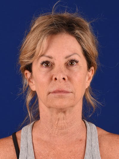 Facelift Before & After Gallery - Patient 911497 - Image 1