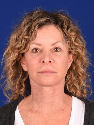 Facelift Before & After Gallery - Patient 911497 - Image 2