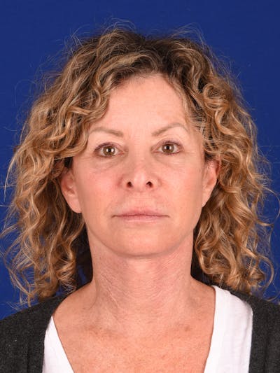 Facelift Before & After Gallery - Patient 911497 - Image 2