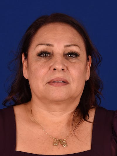 Facelift Before & After Gallery - Patient 188195 - Image 1