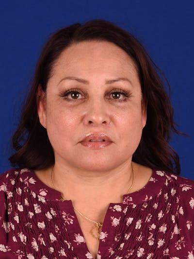 Facelift Before & After Gallery - Patient 188195 - Image 2