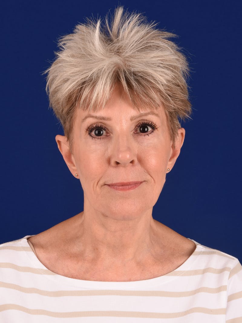 Facelift Before & After Gallery - Patient 291512 - Image 1