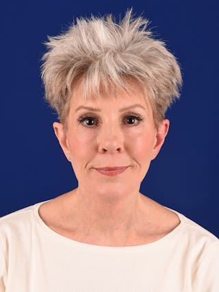 Facelift Before & After Gallery - Patient 291512 - Image 2