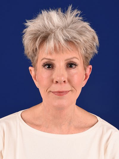 Facelift Before & After Gallery - Patient 291512 - Image 2