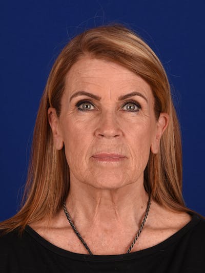 Facelift Before & After Gallery - Patient 162082285 - Image 1