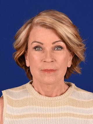 Facelift Before & After Gallery - Patient 162082285 - Image 2