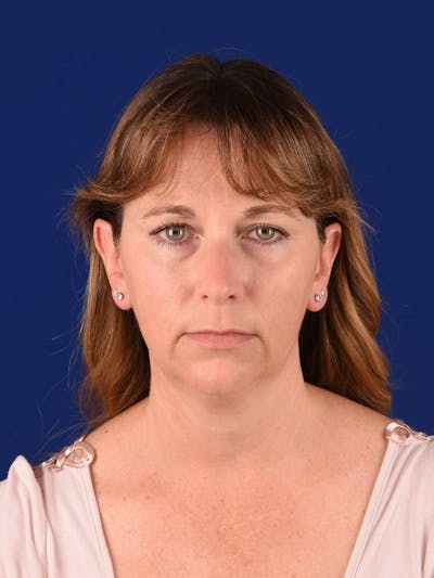 Facelift Before & After Gallery - Patient 138473 - Image 1