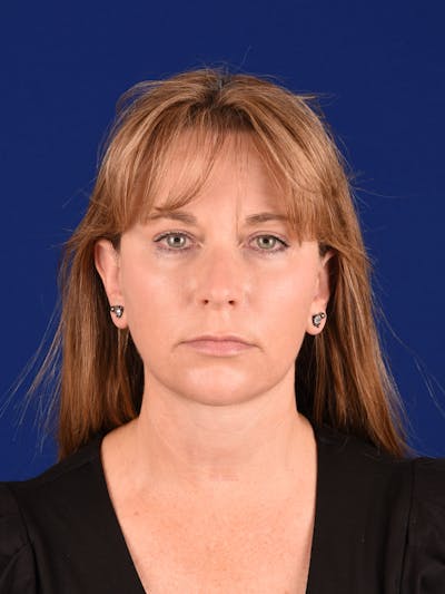 Facelift Before & After Gallery - Patient 138473 - Image 2