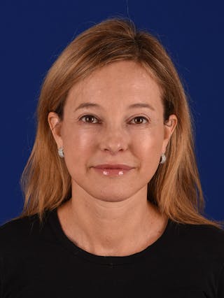 Facelift Before & After Gallery - Patient 143045 - Image 2