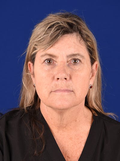 Facelift Before & After Gallery - Patient 140912 - Image 1