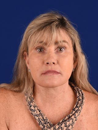 Facelift Before & After Gallery - Patient 140912 - Image 2