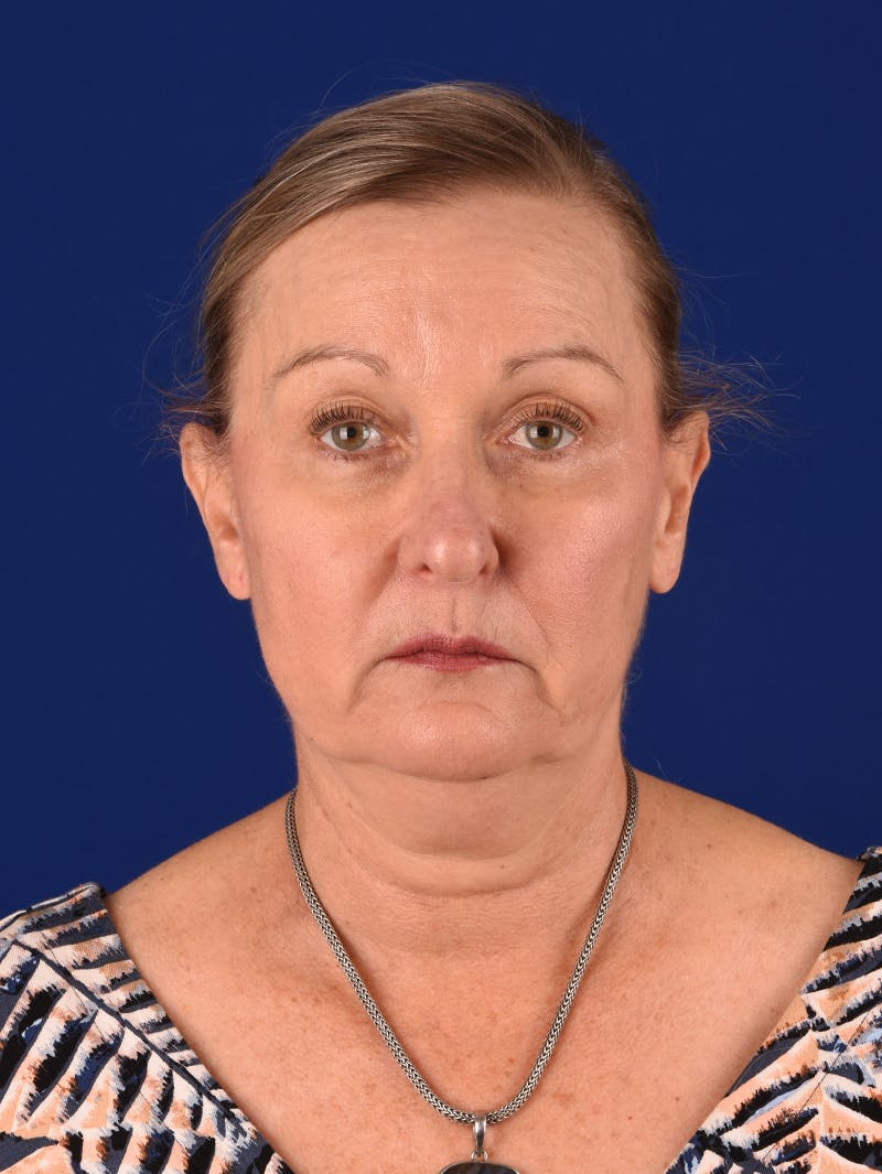 Facelift Before & After Gallery - Patient 196535 - Image 1