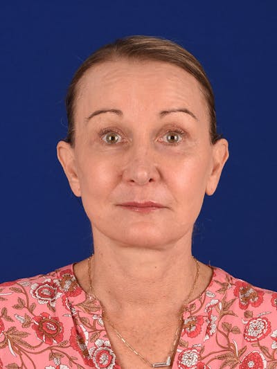 Facelift Before & After Gallery - Patient 196535 - Image 2