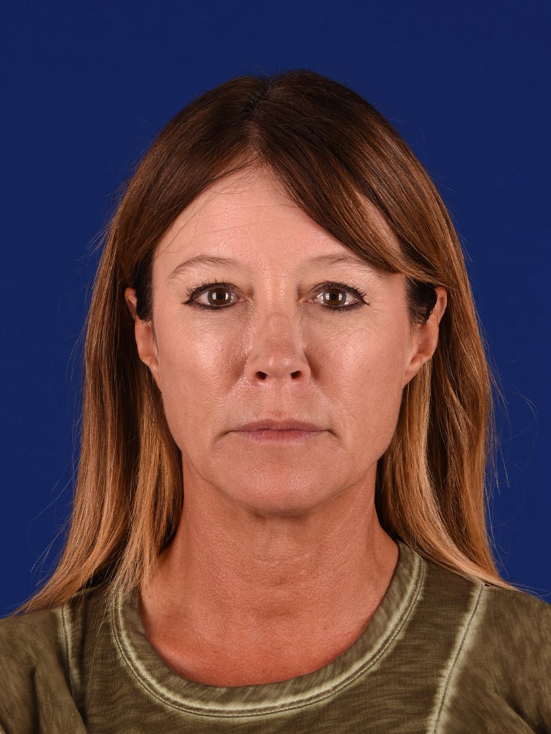Facelift Before & After Gallery - Patient 349581 - Image 1