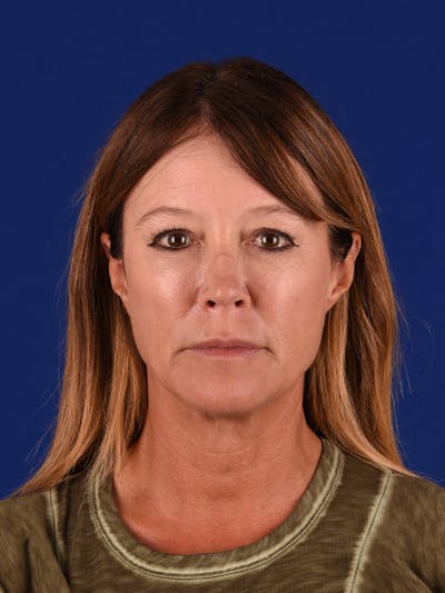 Facelift Before & After Gallery - Patient 349581 - Image 1