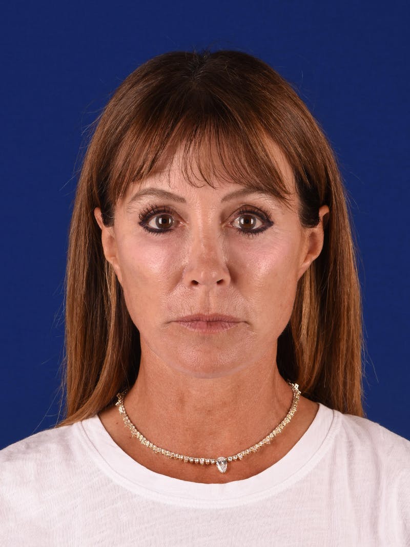 Facelift Before & After Gallery - Patient 349581 - Image 2