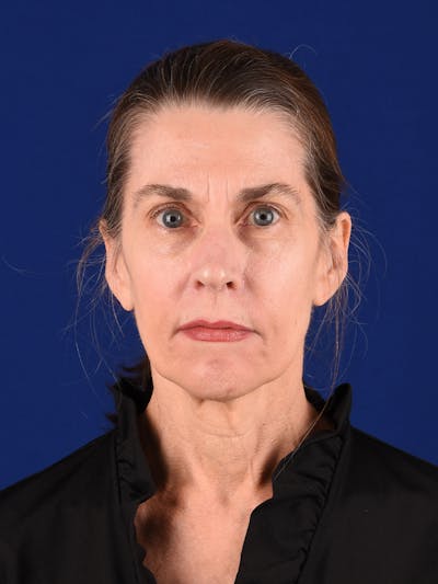 Facelift Before & After Gallery - Patient 196216 - Image 1