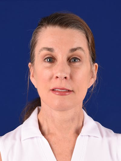 Facelift Before & After Gallery - Patient 196216 - Image 2