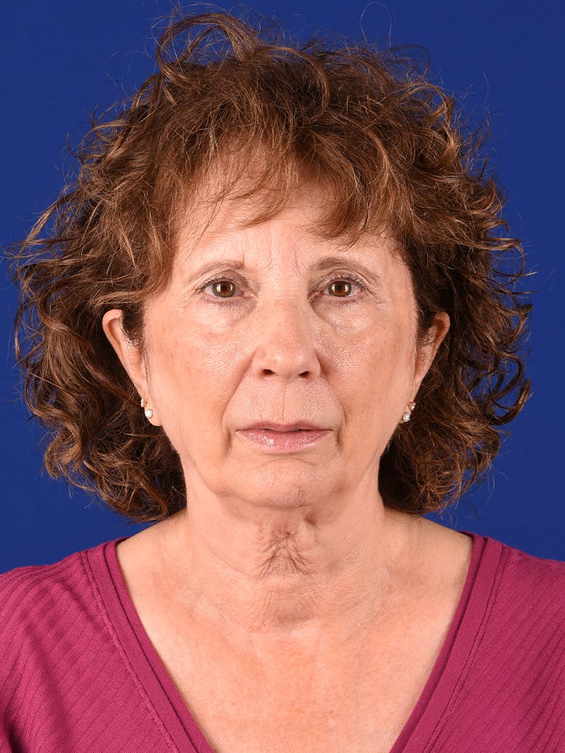 Facelift Before & After Gallery - Patient 392392 - Image 1