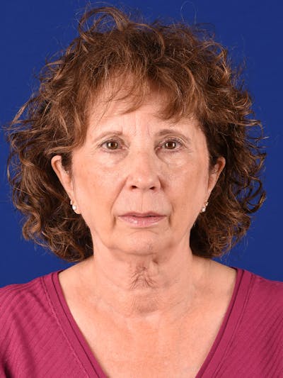 Facelift Before & After Gallery - Patient 392392 - Image 1