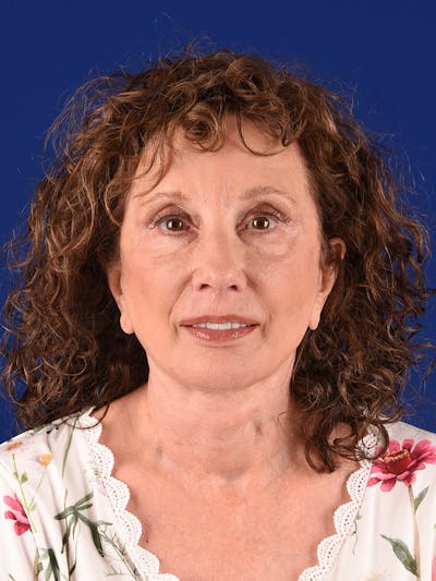 Facelift Before & After Gallery - Patient 392392 - Image 2