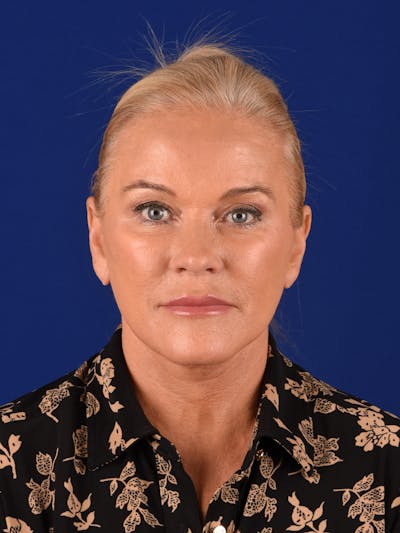 Facelift Before & After Gallery - Patient 350021 - Image 2