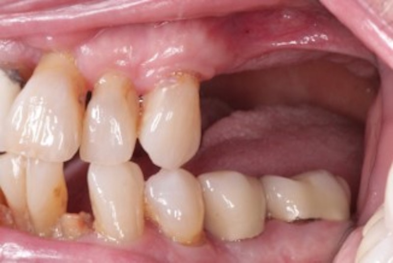 Removing a Retained Root Technique and Procedure?