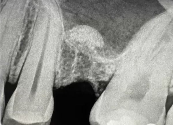 crestal lift xray